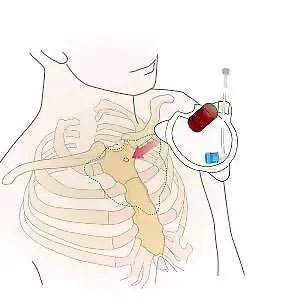 FAST1 Intraosseous Infusion System - Teleflex