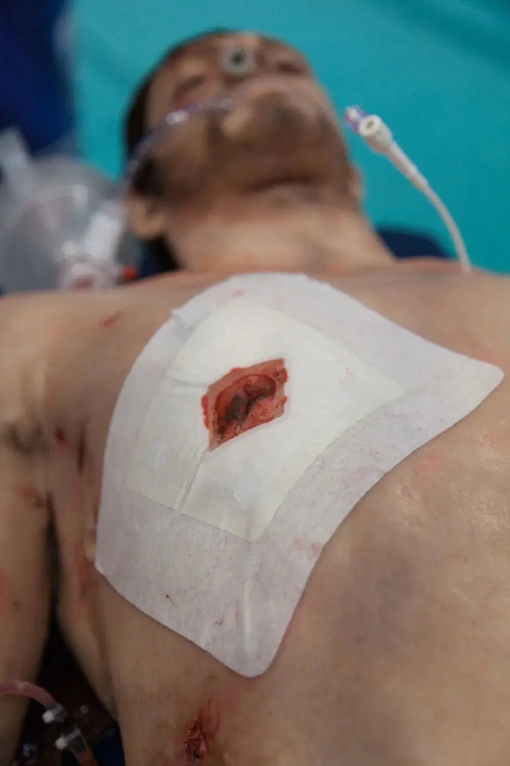 Russell Chest Seal - Safeguard Medical