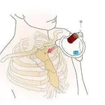 FAST1 Intraosseous Infusion System - Teleflex
