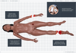 SIMBODIES Procedural Trauma Diagram