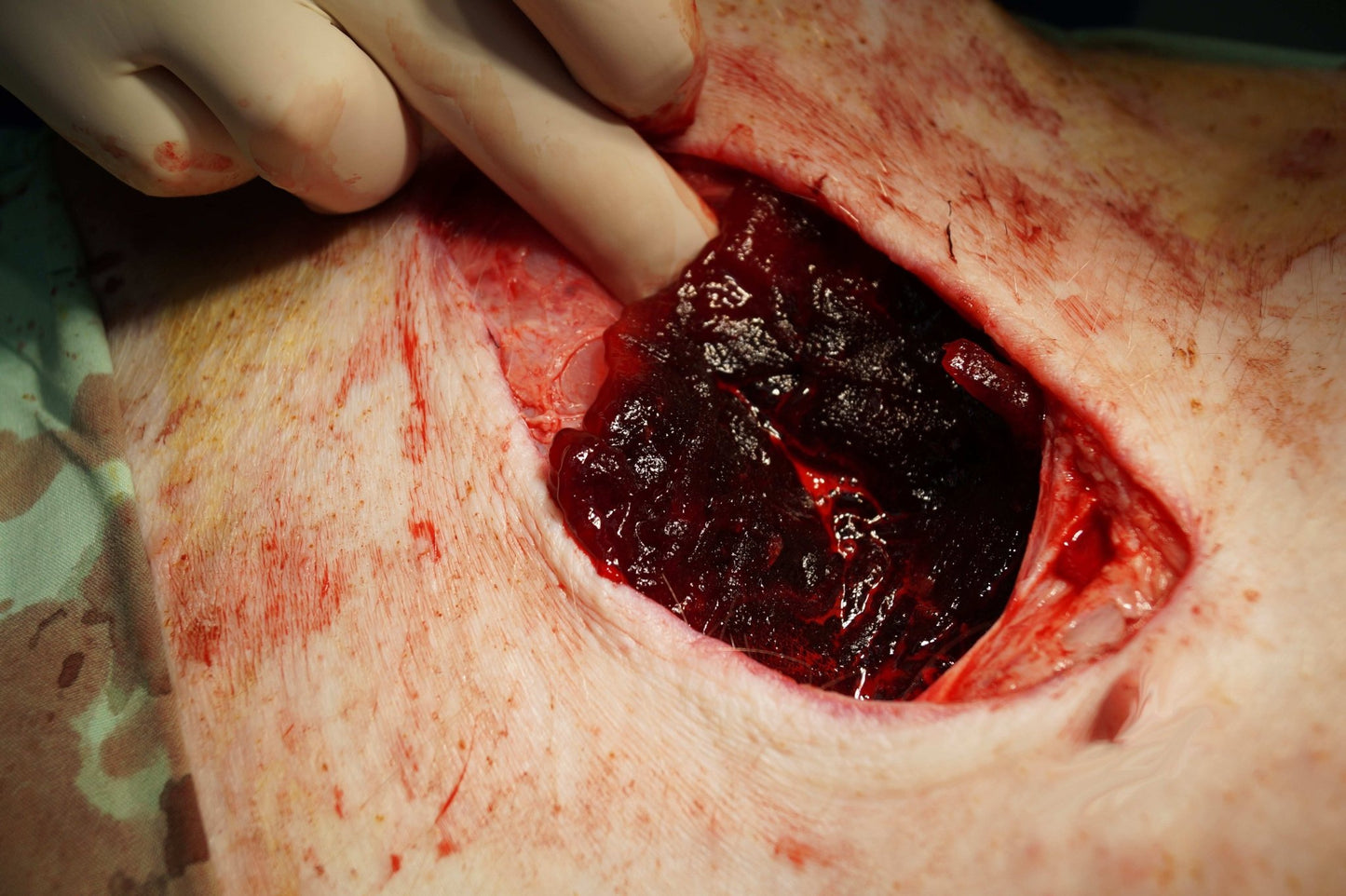 WoundClot® EMS Hemostatic Gauze, Z - Fold — 3" x 39" - WoundClot