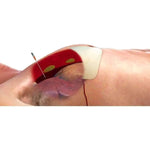 ARS for Needle Decompression - North American Rescue
