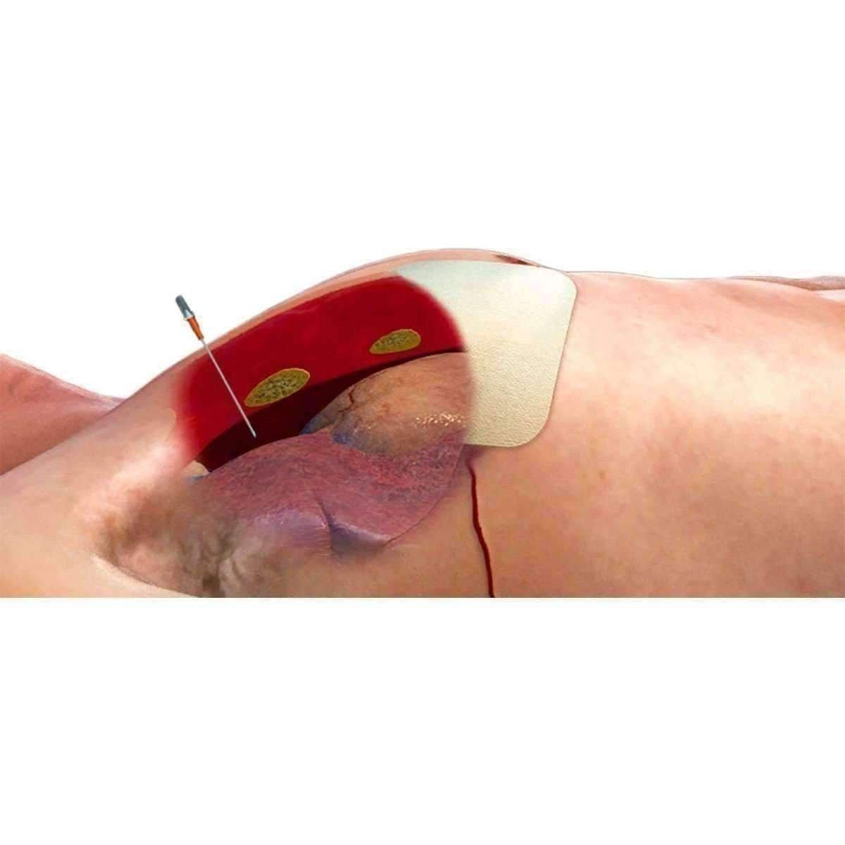 ARS for Needle Decompression North American Rescue