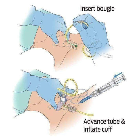 Bougie-Aided Cricothyroidotomy Pack (BAC-Pack™) - Vendor