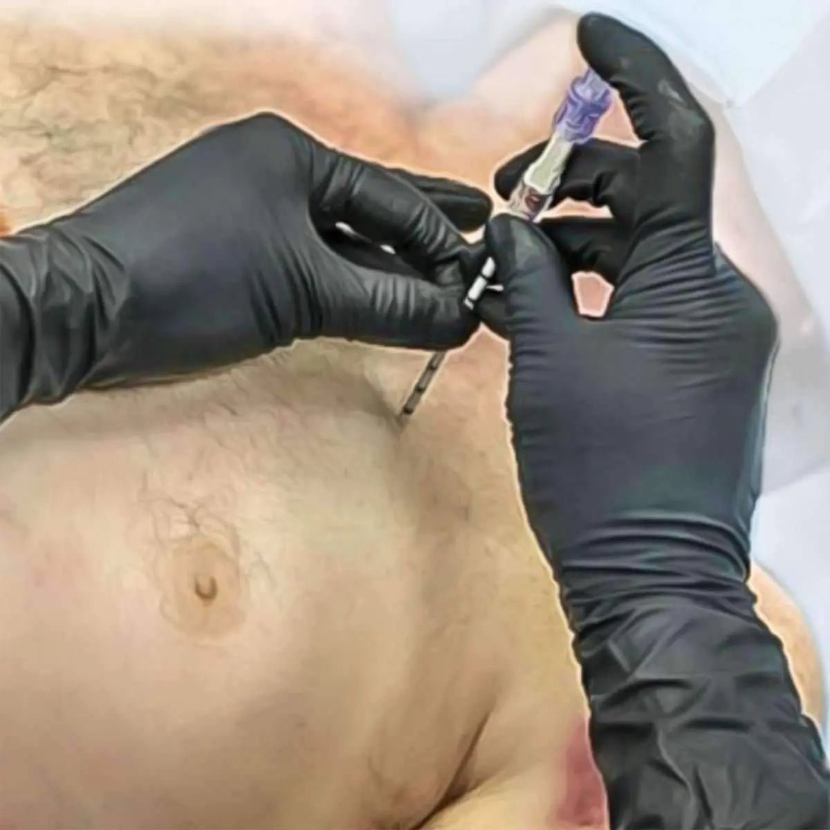 SPEAR - Simplified Pneumothorax Emergency Air Release) Device - North American Rescue