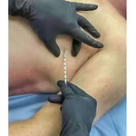 SPEAR - Simplified Pneumothorax Emergency Air Release) Device - North American Rescue